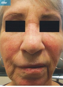 VBeam after photo, front view (case 9359)