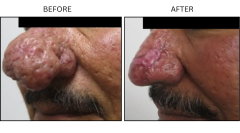LB Surgical Rhinophyma - Patient1c