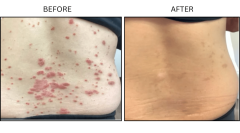 LB Medical Psoriasis - Patient1