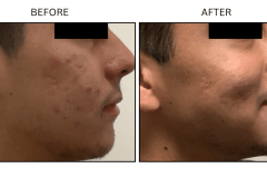 LB Medical Acne - Patient18