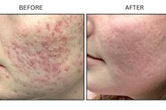 LB Medical Acne - Patient10