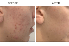 LB Medical Acne - Patient19