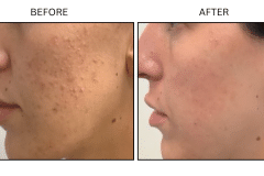 LB Medical Acne - Patient20