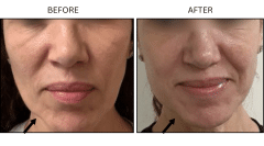 LB Fillers Cheeks - Patient2a