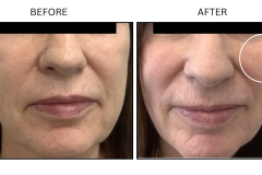 LB Fillers Cheeks - Patient6