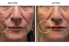 LB Fillers Cheeks - Patient8