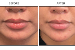 LB Neurotx Relx Chin - Patient1