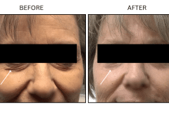 LB Lasers Laser Resurfacing Co2 Laser - Patient11