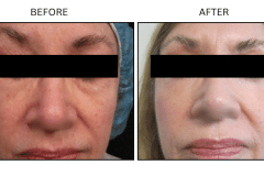 LB Lasers Laser Resurfacing Co2 Laser - Patient2a