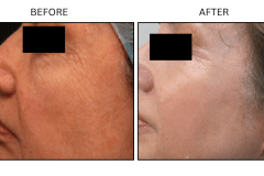 LB Lasers Laser Resurfacing Co2 Laser - Patient2c
