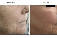 LB Lasers Laser Resurfacing Co2 Laser - Patient3