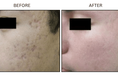 LB Lasers Laser Resurfacing Co2 Laser - Patient5