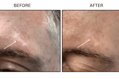 LB Lasers Laser Resurfacing Co2 Laser - Patient12