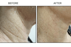 Lasers Laser Resurfacing Co2 Laser - Patient4
