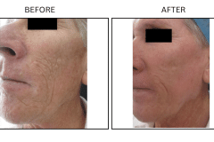 LB Lasers Laser Resurfacing Co2 Laser - Patient7a
