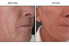 LB Lasers Laser Resurfacing Co2 Laser - Patient7b