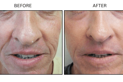 LB Lasers Laser Resurfacing Co2 Laser - Patient7c