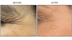 LB Neurotx Relx Crows Feet - Patient1