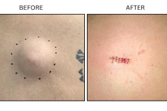 LB Surgical Cysts - Patient1