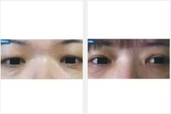 04Eyelid-Surgery