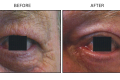 LB Surgical Eyelid Surgery - Patient1
