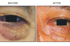 LB Surgical Eyelid Surgery - Patient10