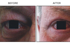 LB Surgical Eyelid Surgery - Patient11