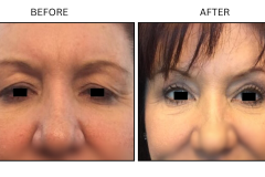 LB Surgical Eyelid Surgery - Patient12