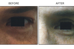 LB Surgical Eyelid Surgery - Patient2