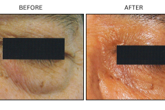 LB Surgical Eyelid Surgery - Patient3