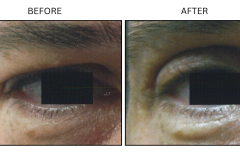 LB Surgical Eyelid Surgery - Patient4