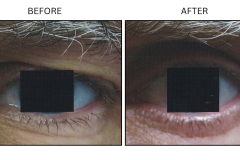 LB Surgical Eyelid Surgery - Patient5
