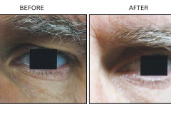LB Surgical Eyelid Surgery - Patient6