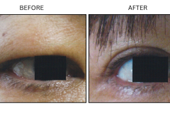 LB Surgical Eyelid Surgery - Patient7