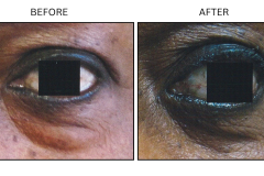 LB Surgical Eyelid Surgery - Patient8