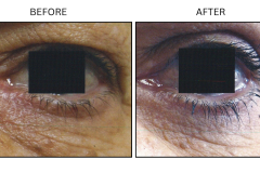 LB Surgical Eyelid Surgery - Patient9
