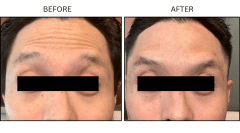 LB Neurotx Relx Forehead - Patient1