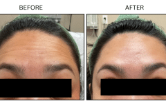 LB Neurotx Relx Forehead - Patient16