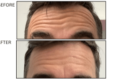 LB Neurotx Relx Forehead - Patient17