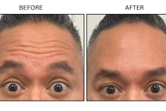LB Neurotx Relx Forehead - Patient8