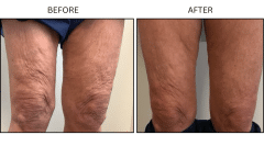 LB Lasers Forma - Patient1