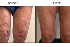 LB Lasers Forma - Patient1