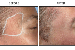 Lasers Fraxel - Patient3