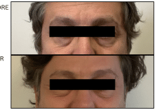 LB Lasers Fraxel - Patient4