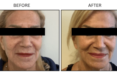 LB Lasers Fraxel - Patient5a