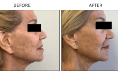 LB Lasers Fraxel - Patient5b