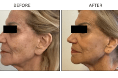 LB Lasers Fraxel - Patient5c