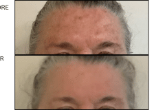 LB Lasers Fraxel - Patient6