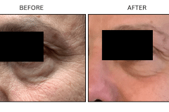 LB Lasers Fraxel - Patient8
