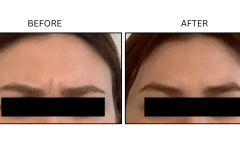 LB Neurotx Relx Glabellar Frown Lines - Patient15